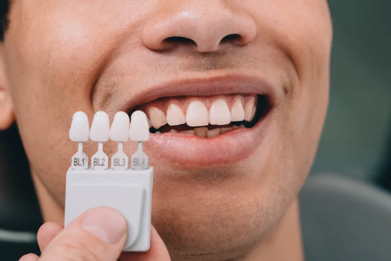 Raymore Family Dentistry|Veneers