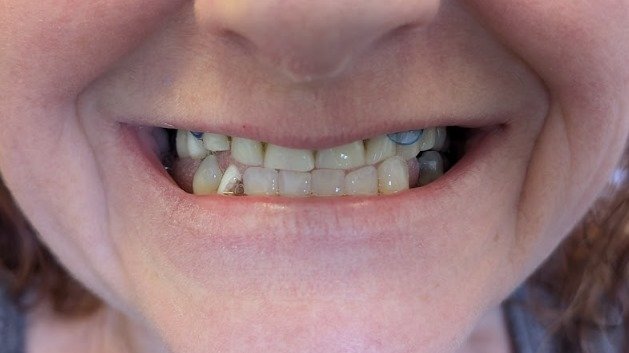 Raymore Family Dentistry | Before & After Photos