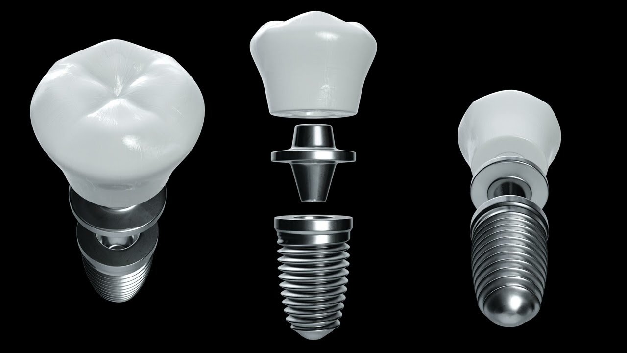 Raymore Family Dentistry|Single Dental Implants