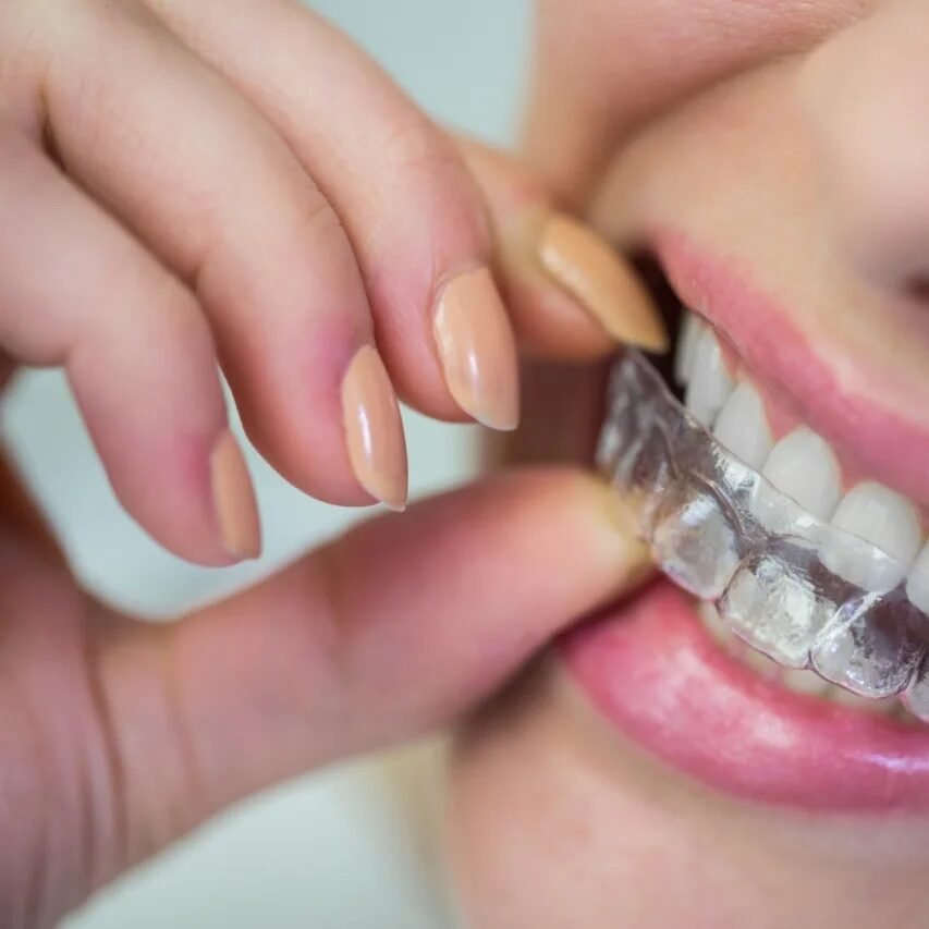 geotagged-invisalign