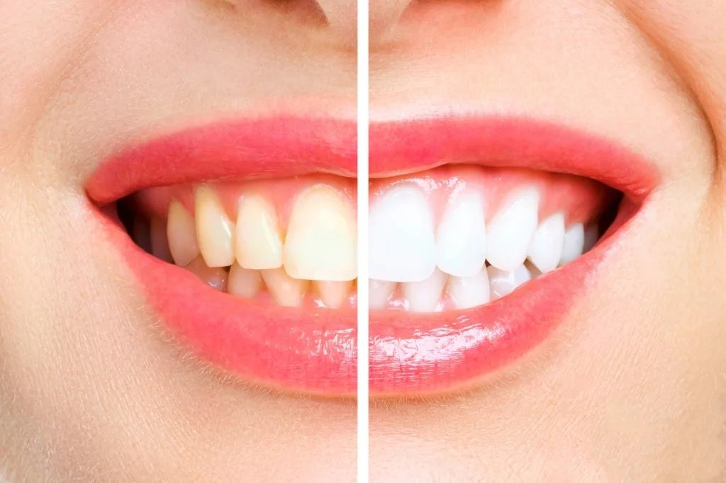 Raymore Family Dentistry|Teeth Whitening / Cleaning