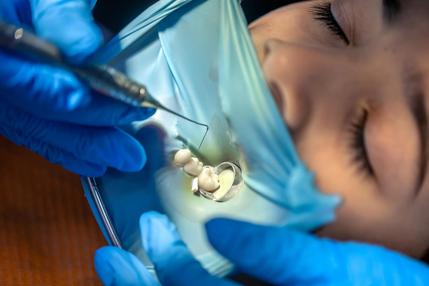 Raymore Family Dentistry|Simple Extractions