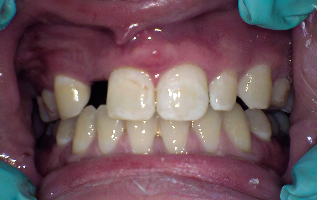 Raymore Family Dentistry | Before & After Photos