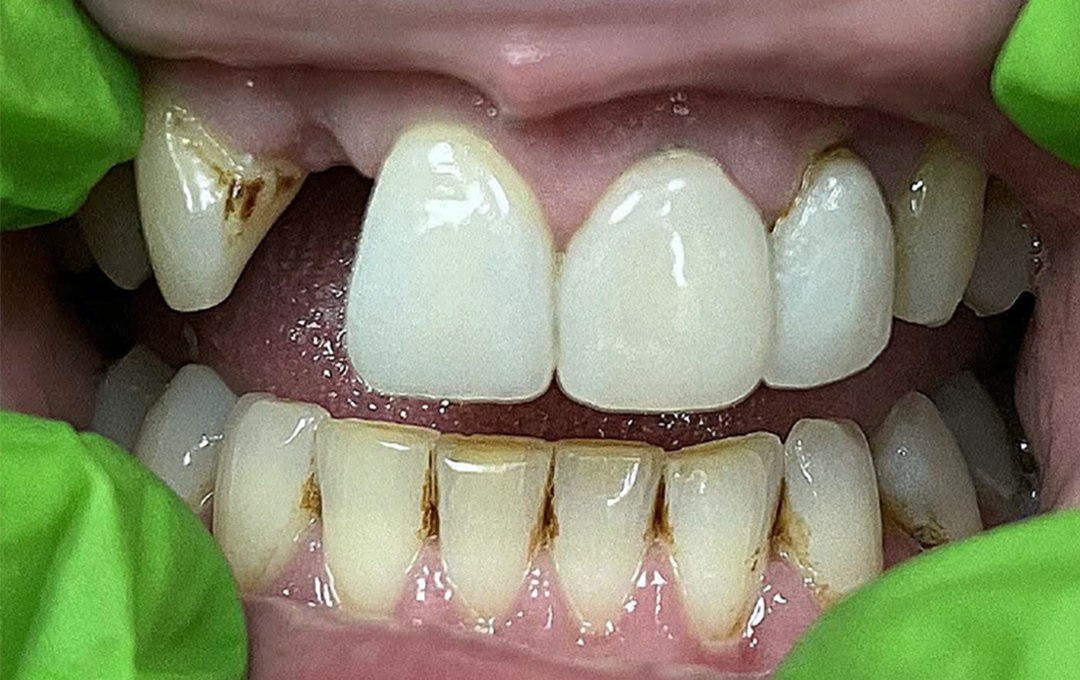 Raymore Family Dentistry | Before & After Photos