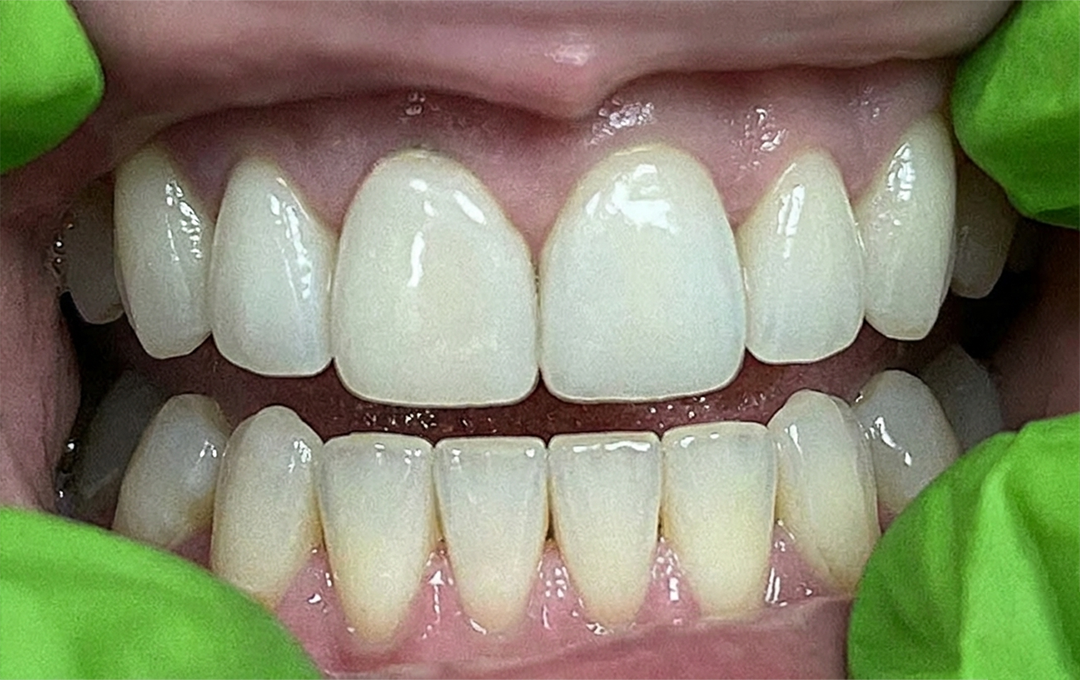 Raymore Family Dentistry | Before & After Photos