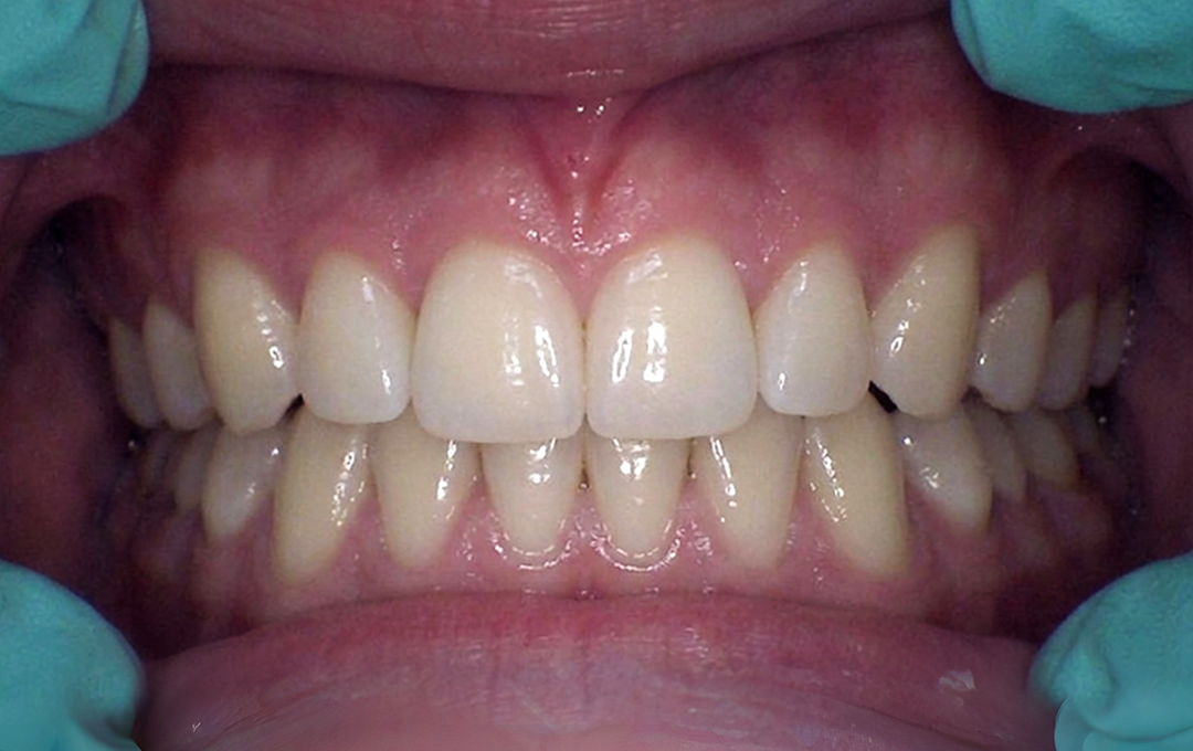 Raymore Family Dentistry | Before & After Photos