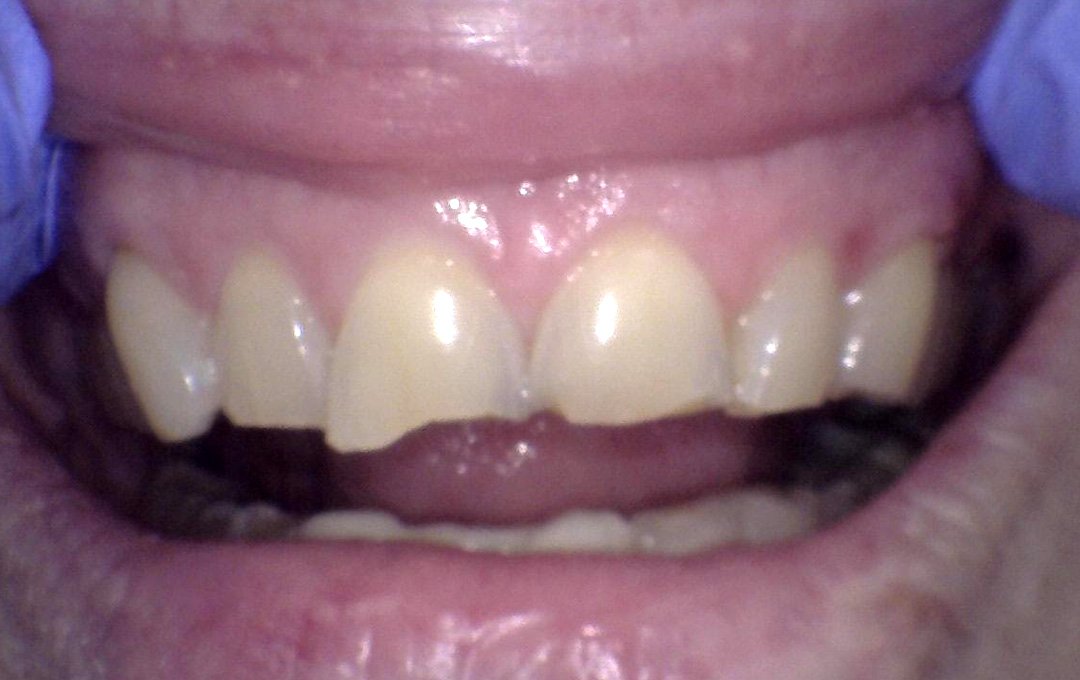 Raymore Family Dentistry | Before & After Photos