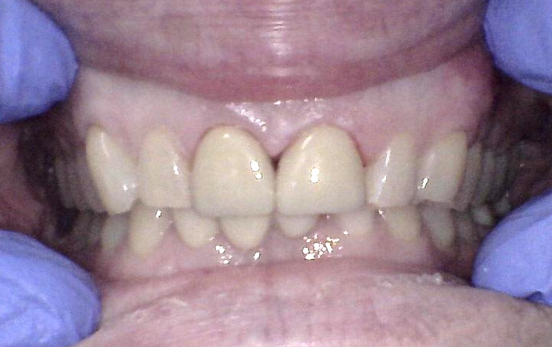 Raymore Family Dentistry | Before & After Photos Raymore Family Dentistry | Before & After Photos