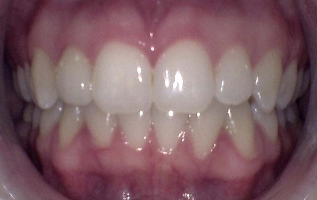 Raymore Family Dentistry | Before & After Photos
