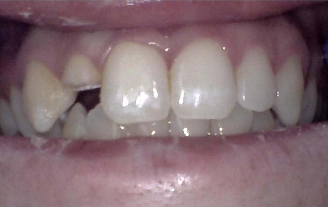 Raymore Family Dentistry | Before & After Photos